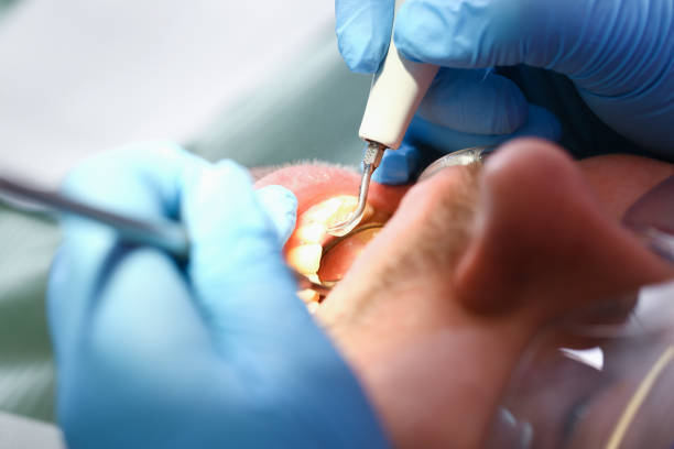 Best Emergency Tooth Extraction in Reform, AL